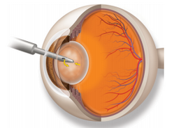 שאיבת העדשה העכורה - ניתוח קטרקט cataract